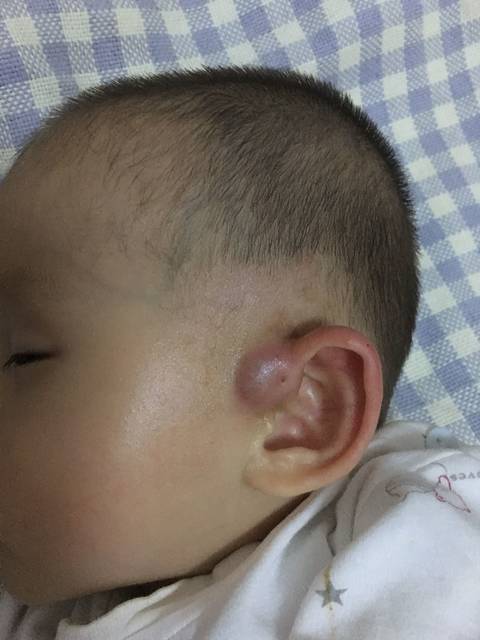 耳前瘘管,再也不怕你了