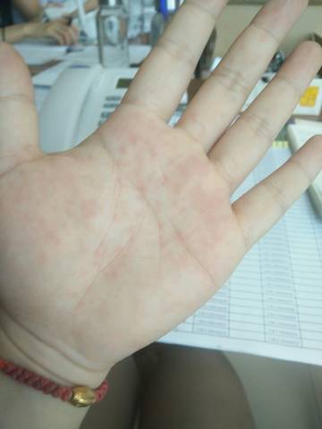 求助贴_我一到夏天手上都长小水泡,手掌还出现