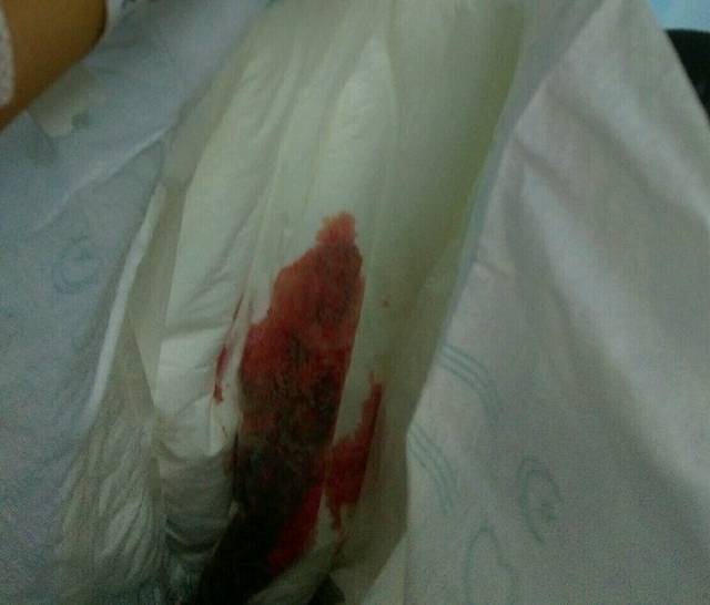 孕25周，胎宝宝一切正常，宫颈口打开，卧床保胎中!