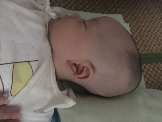 宝宝后脑勺两侧凸起包像两个角怎么回事?