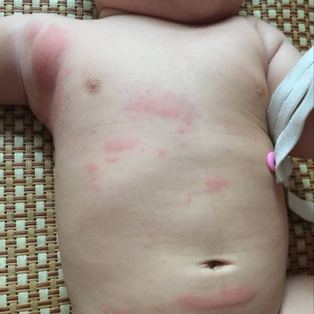 宝宝急性荨麻疹怎么办