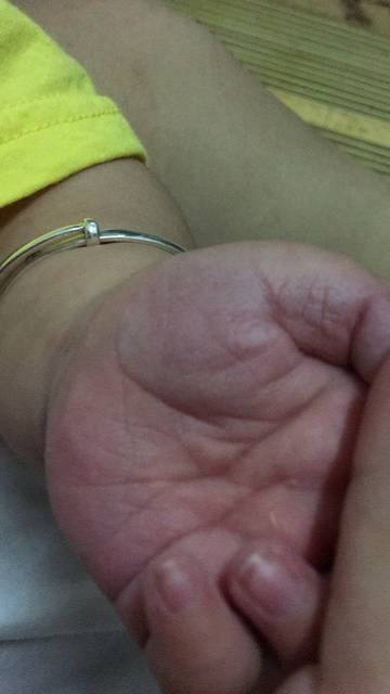 急!宝宝手掌两侧与指尖发红