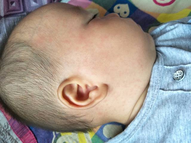 宝宝八个月了脸上 脖子上都是红疹子
