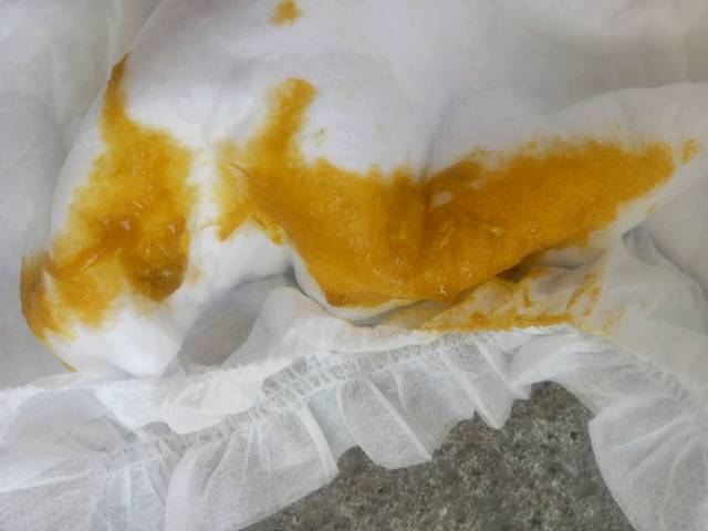 便便有9种颜色,只有3种是健康的(附健康九色卡