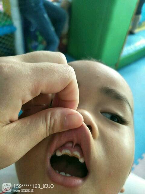 宝宝牙齿什么肿了一个_宝宝吃奶粉吃的牙齿腐