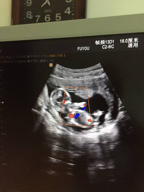 看nt彩超图辨男女,麻烦有经验的帮我看看,感谢!