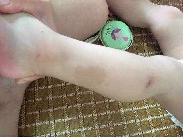 宝宝今天检查得了牛奶咖啡斑,有这种的吗