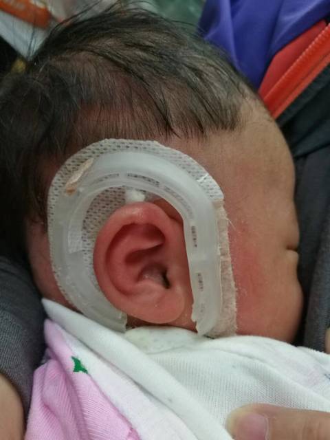 外耳廓畸形_宝宝两个耳朵长的不一样 外耳廓和