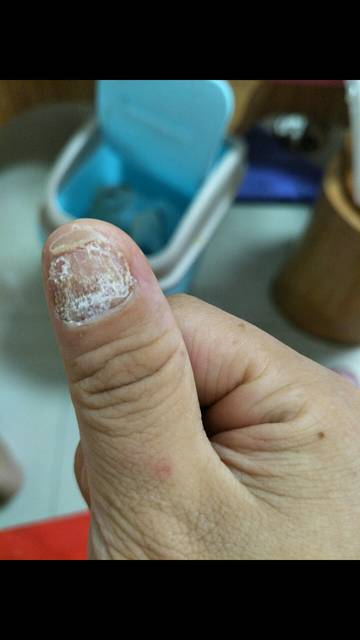 我的灰指甲好啦!不是广告哦,有图慎入