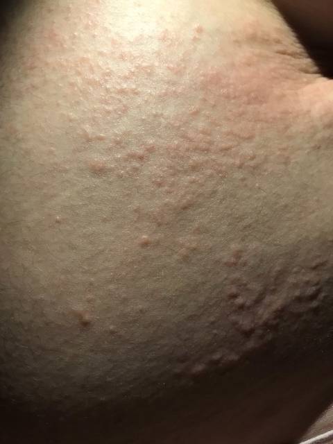 痒到崩溃,痒到泪奔,我身上是怎么回事呀_从肚