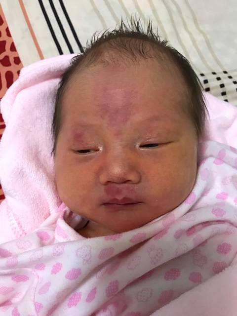 新生儿出生时脸上的红印会褪掉吗