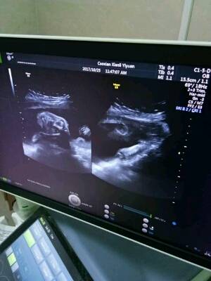 六个月今天做的四维彩超,发现胎儿左侧背部有