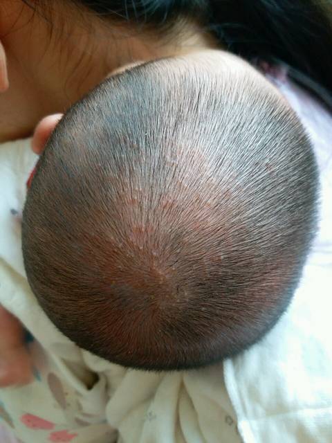 36天宝宝脸上头顶起了好多小红点,最近也咳嗽