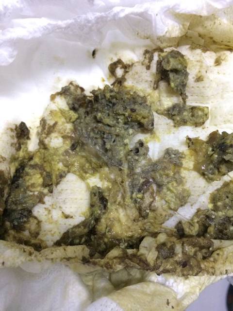 便便有9种颜色,只有3种是健康的(附健康九色卡