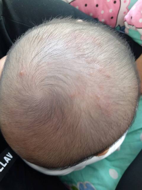 宝宝头上长脓包_宝宝头皮上长了好多脓包 而且