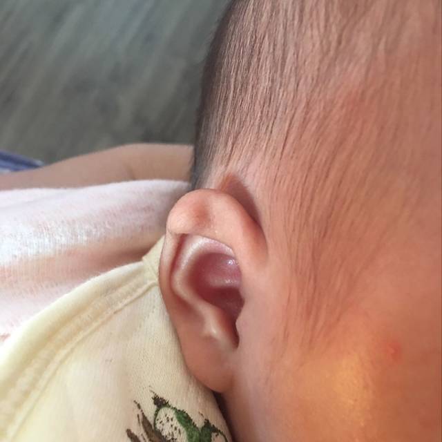 宝宝两个耳朵不一样_宝宝两个耳朵长的不一样