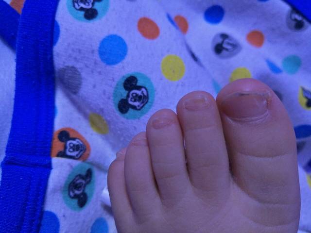 宝宝脚趾甲异常_一岁半的宝宝脚趾甲为什么长