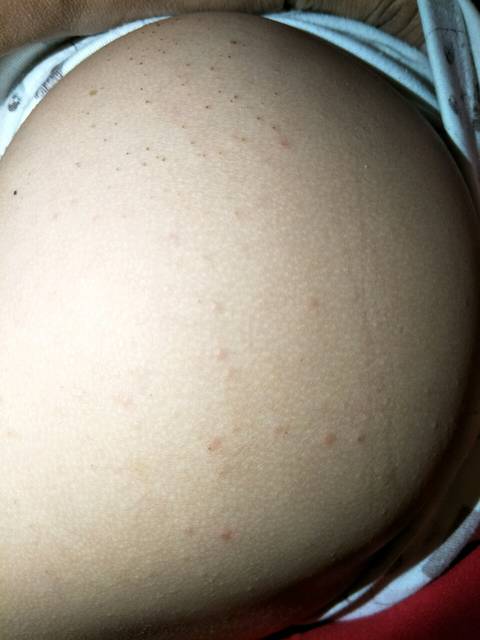 小疙瘩_宝宝2周岁屁股两边最近出现小疙瘩,有