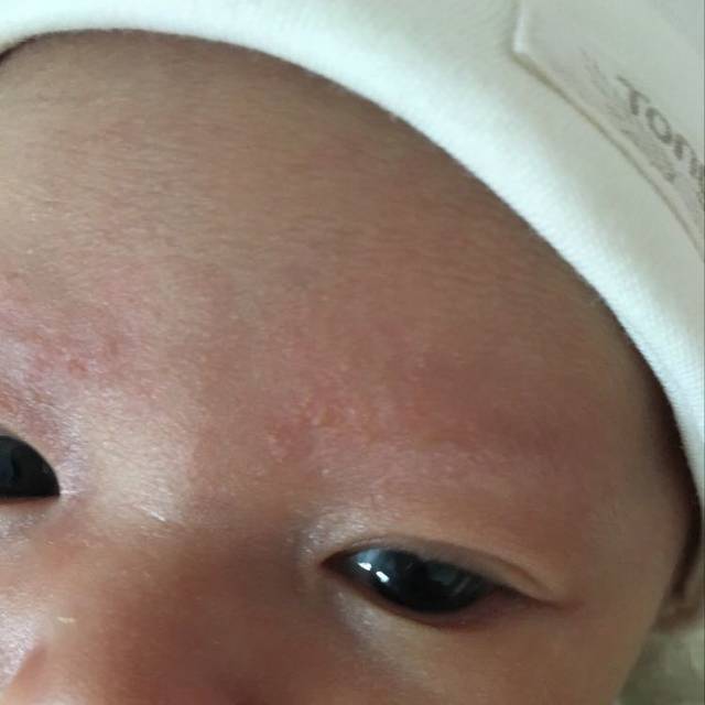 宝宝脸上身上都起了这种红点点。实穿的太多还