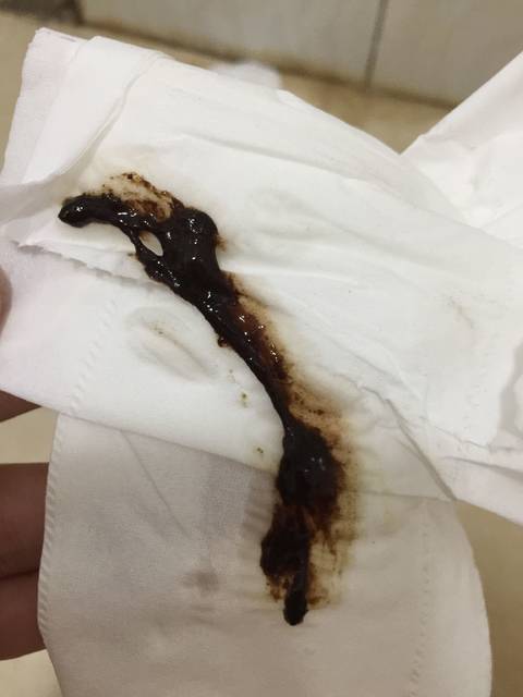 褐色分泌物增多需用卫生巾正常吗_末次月经是