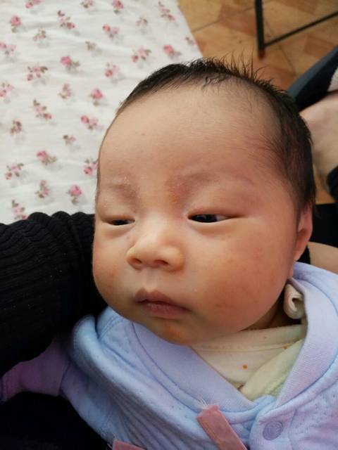 是湿疹还是热疹?_宝宝脸上想那么多这个痘痘