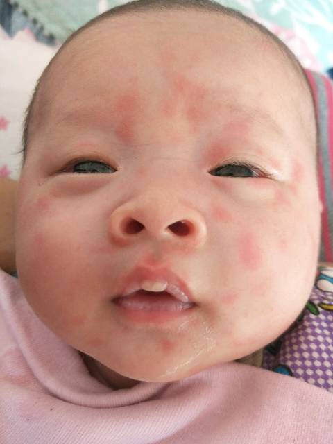 新生儿一个月反复起红色疙瘩中间有一个小白点