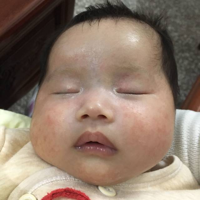 湿疹_宝宝脸上有湿疹该怎么治