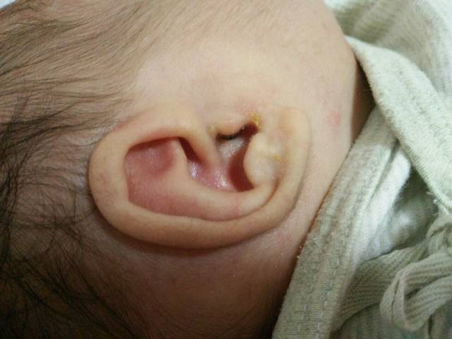 帮忙看一下_宝妈们我家宝宝耳朵有湿疹怎么有