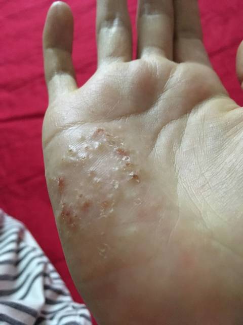 有没有跟我一样的手掌长水泡_非常痒,医生开的