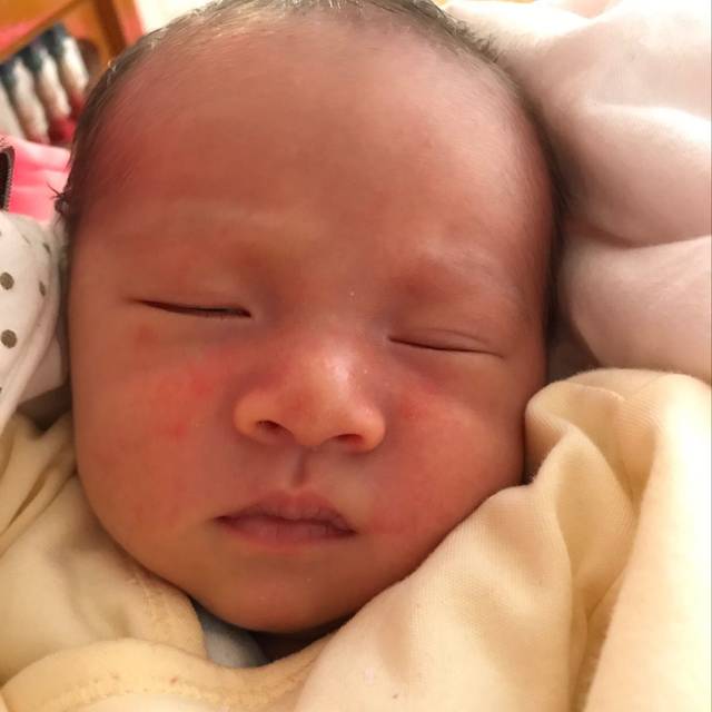 18天新生宝宝脸上长了一点点红红的,哪位宝妈