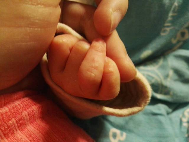 宝宝出生半个月手指头上起的小疙瘩不知道是湿