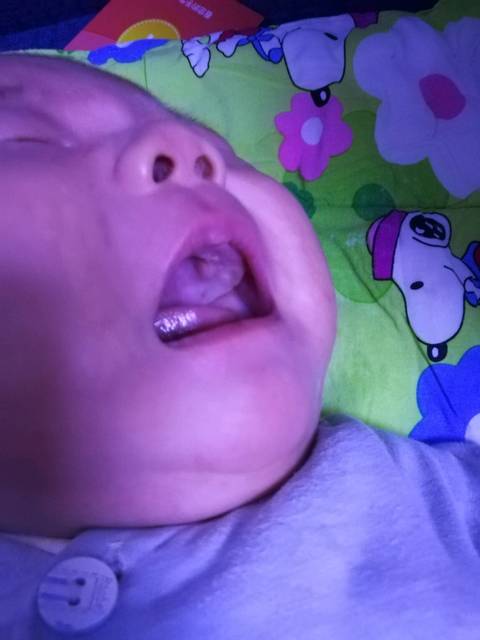 婴儿上牙龈边上长了个肉包