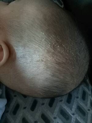 宝宝三个多月,头上很厚头皮,有点黄黄结痂的感