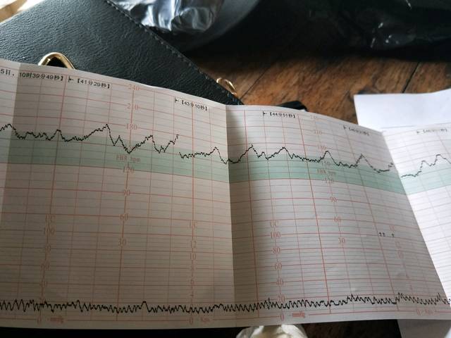 急,胎心监护不合格,医生说话的好吓人