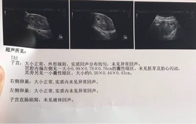 医院检查,医生说怀孕47天了,但是做B超未见胚