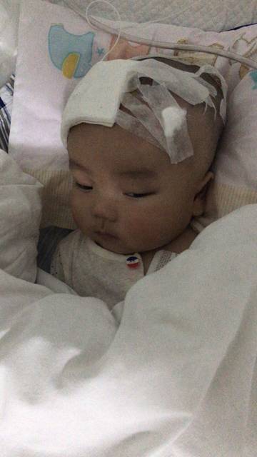 脑积水手术后图片 22908 360x640