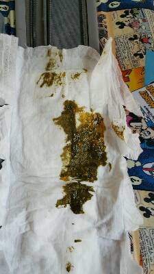 宝宝44天因母乳拉肚子和湿疹,换了雅培亲护奶