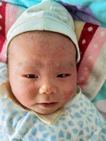 宝宝两个月27天,湿疹特别厉害,全身有点发红掉