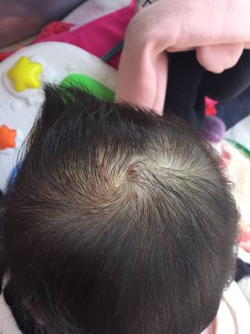 宝宝九个月,头上反反复复起小红点,看着不像湿