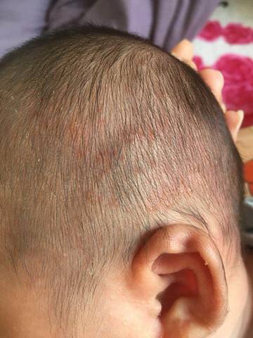50天宝宝脸上头皮长满红点能打预防针吗?