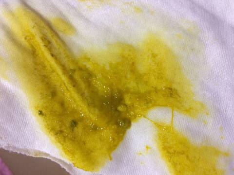 直大便稀,次数多,喂点妈咪爱好点,屁屁红,破皮,