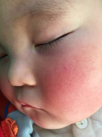 宝宝发烧之后脸上起了好些小白点,好长时间了