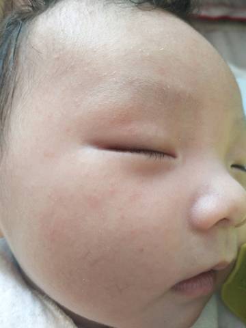 宝宝脸上起小疙瘩,怎么也不消退,是湿疹,痱子还