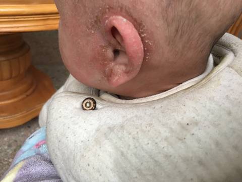 我家宝宝湿疹特别严重尤其是耳朵后面流水结痂