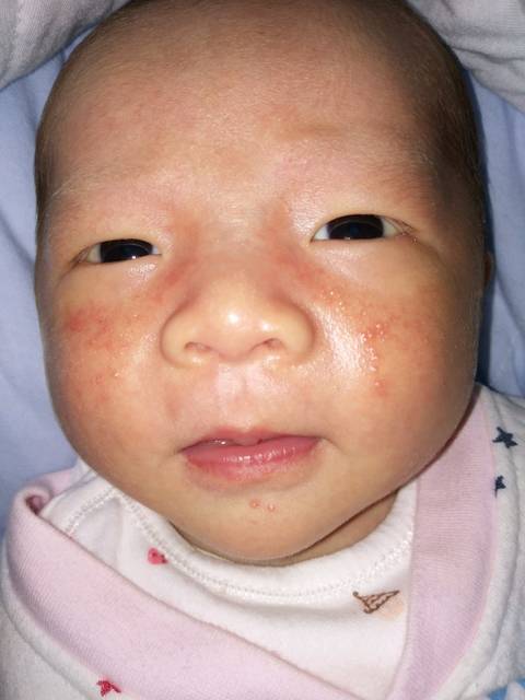 宝宝脸上是湿疹还是热疹啊,有懂的吗?帮忙看下