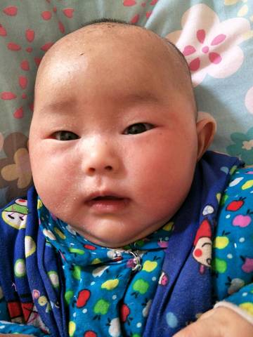 宝4个月大,脸上眼角,嘴周围,耳朵周围和胳膊上