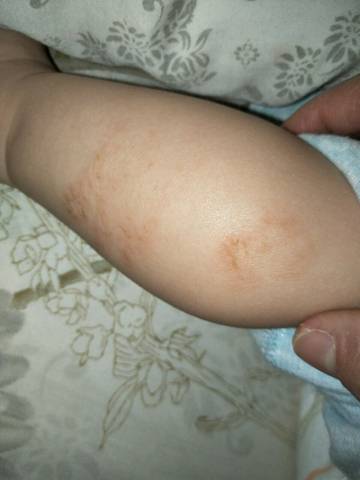 八个多月宝宝小腿有裂纹,遇热水会发红,平时是肤色干纹皮,像是结的一
