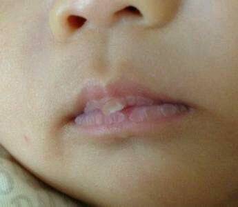 宝宝上嘴唇有很大的奶泡怎麼办?大家帮忙看看