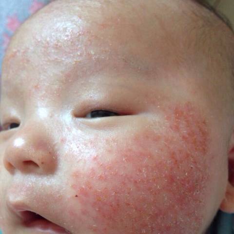 宝宝是这种干性湿疹,就只有脸上有,不算严重,涂