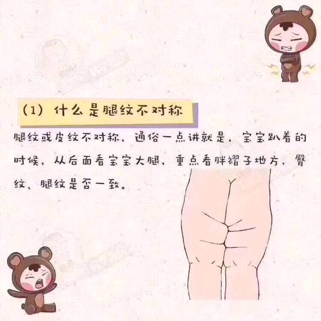 腿纹不对称，就是髋关节发育不良吗?